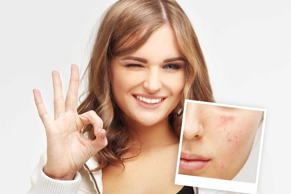 Cómo cuidar la piel con acné - Farmacia Avenida América