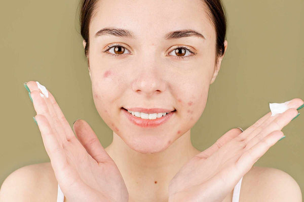 Estos son los 11 productos para cuidar el acné que transformarán tu piel